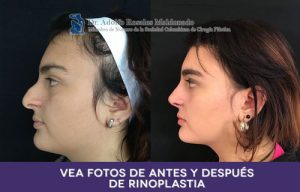 Rinoplastia - Cirugía de nariz mujeres - Rinoplatia en Bogotá - Experto en Rinoplastia 