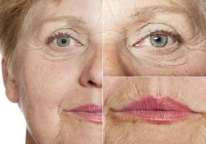 Rejuvenecimiento facial - estiramiento facial - tratamientos antienvejecimiento - Procedimientos para rejuvenecer la piel