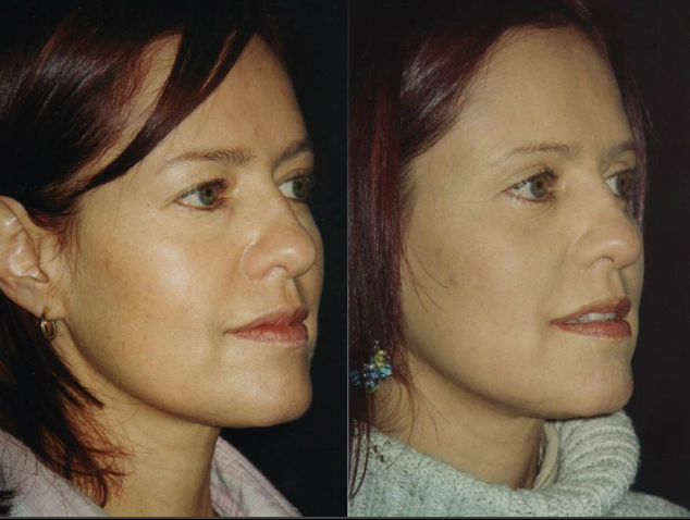 Blefaroplastia superior e inferior más Cantopexia