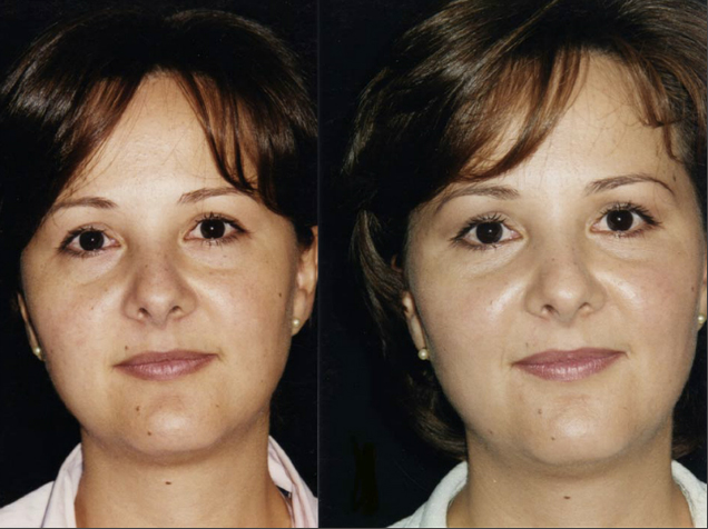 Blefaroplastia inferior sin resección de piel. Resultado al año