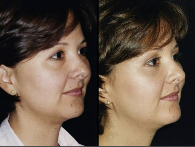 Blefaroplastia inferior sin resección de piel. Resultado al año