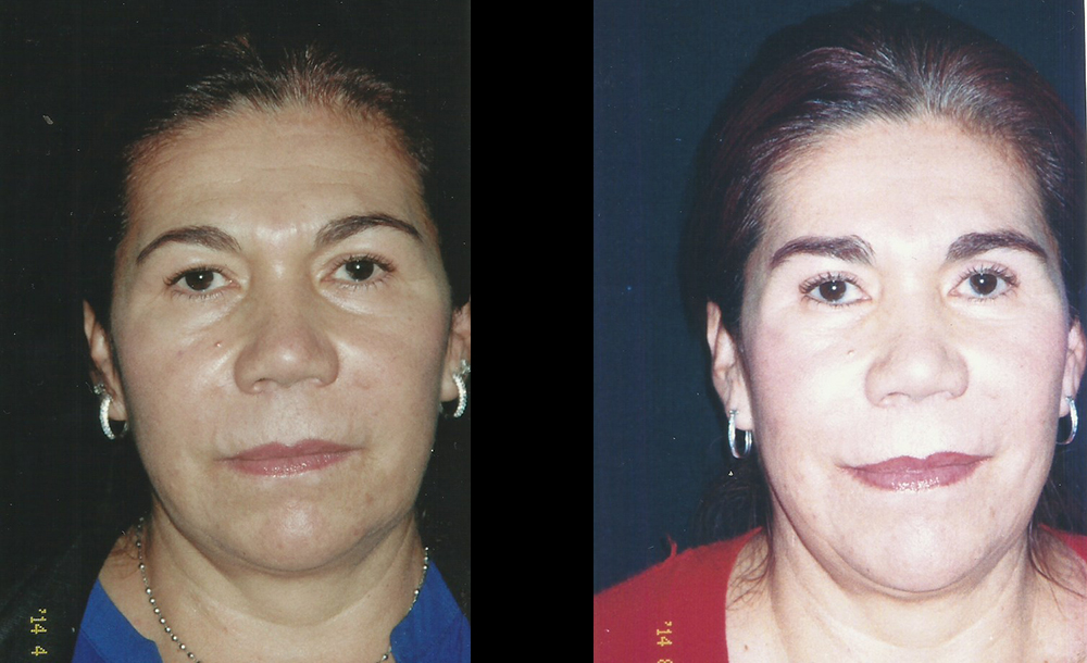 Blefaroplastia superior e inferior + elevación de cejas