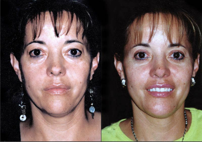 Mentoplastia + Liposucción de papada + Blefaroplastia superior e inferior