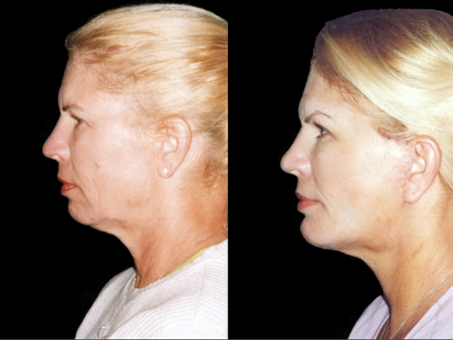 Implante de mentón + Elevación de cejas + rejuvenecimiento de cuello y mejillas Antes
