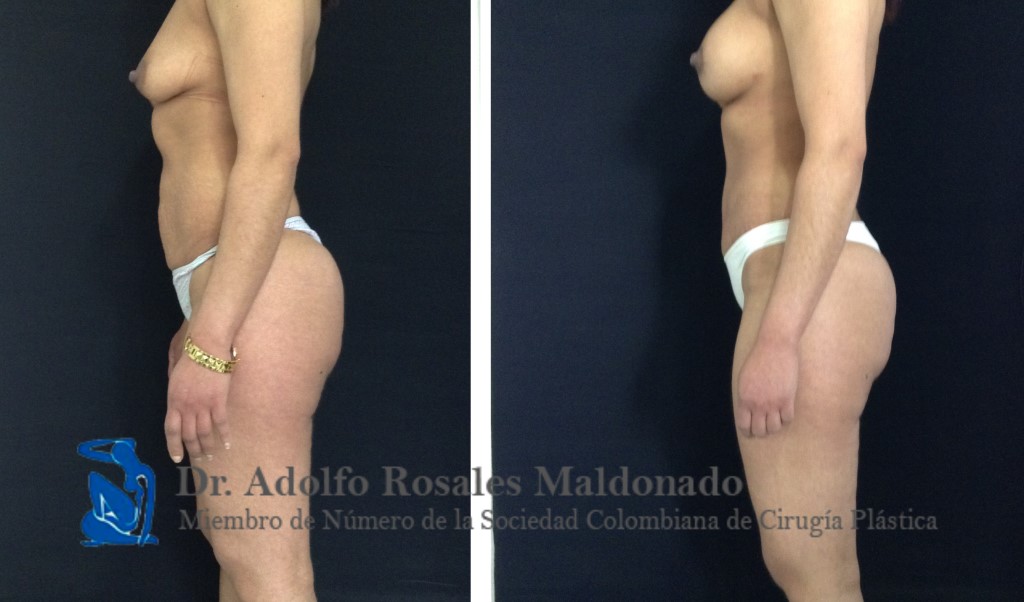 Abdominoplastia + Liposucción de Cintura + Mamoplastia de aumento sin cicatriz visible Resultados a los 3 meses