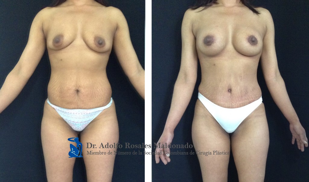 Abdominoplastia + Liposucción de Cintura + Mamoplastia de aumento sin cicatriz visible Resultados a los 3 meses