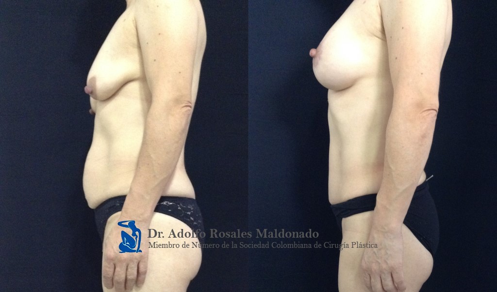 Liposucción de pliegue axilar posterior + espalda + cintura + cadera + Mamoplastia de aumento con levantamiento peri areolar + Abdominoplastia Resultados al año