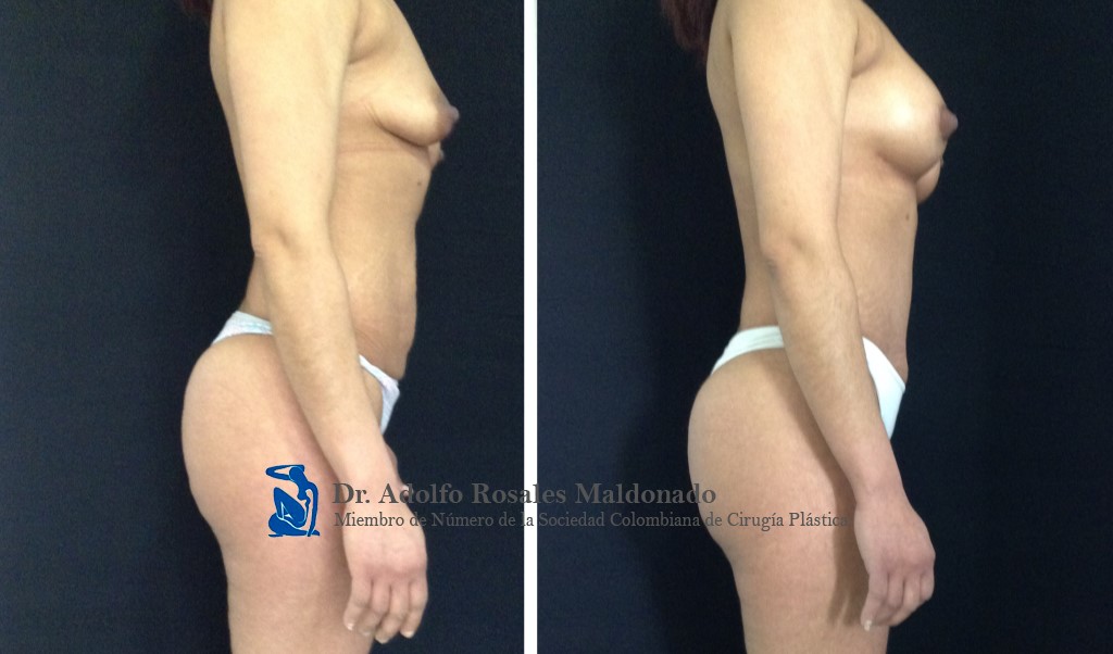 Mamoplastia de aumento sin cicatriz visible + Abdominoplastia + Liposucción de Cintura Resultados a los 3 meses