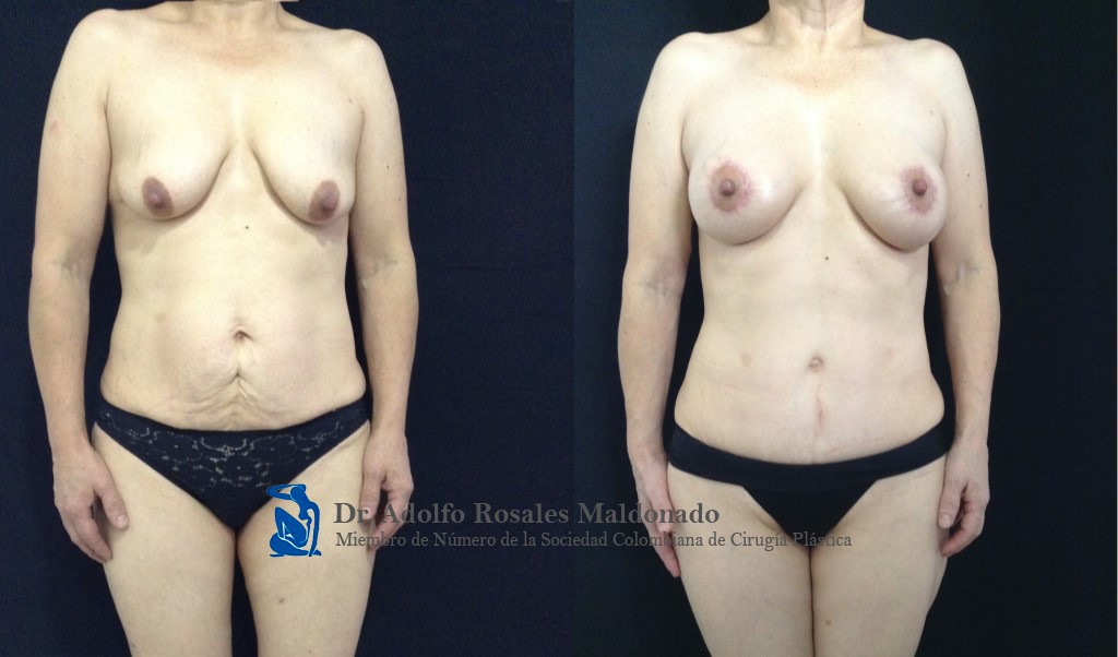 Mamoplastia de aumento con levantamiento peri areolar + Abdominoplastia + Liposucción de pliegue axilar posterior + espalda + cintura + cadera Resultados al año