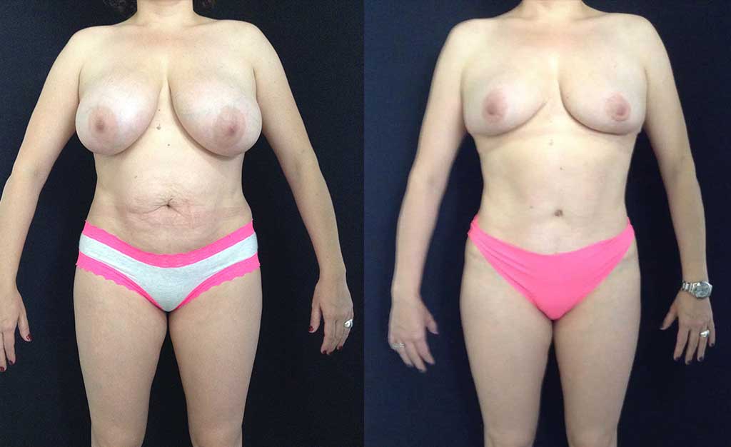 Cirugía múltiple del cuerpo: Mamoplastia de reducción + abdominoplastia resultado a los 5 meses de cirugía.