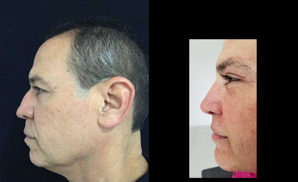 Aumento de radix + aumento dorso cartilaginoso + definición y proyección punta nasal resultado al año de cirugía