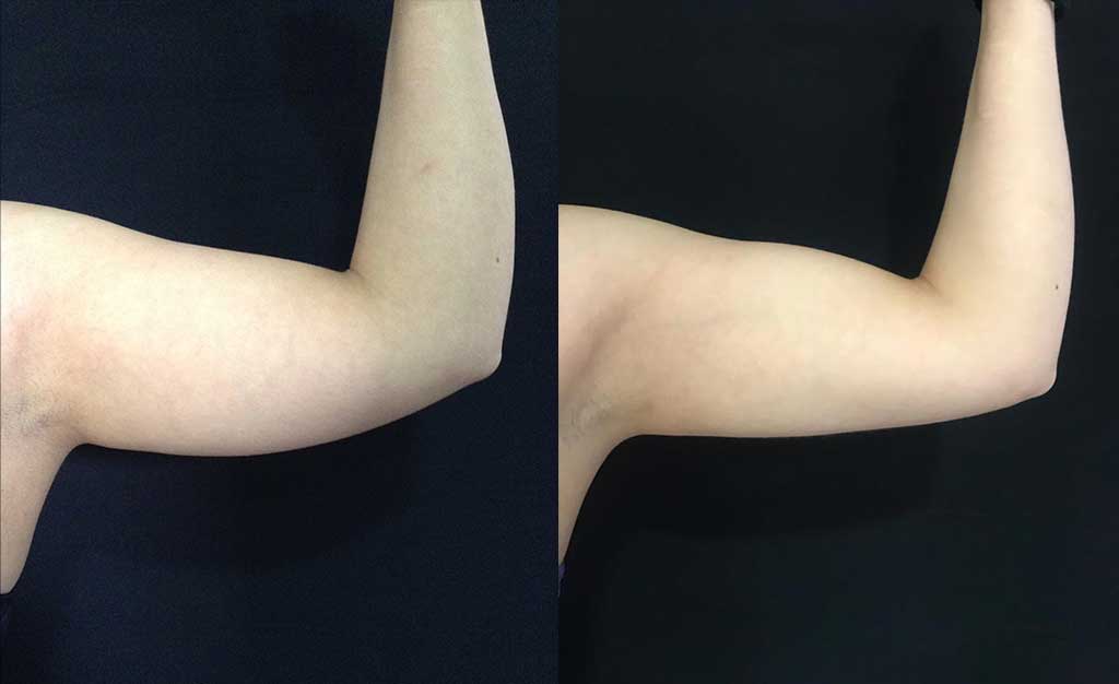 Liposucción de brazos resultados a los 8 meses de cirugía.