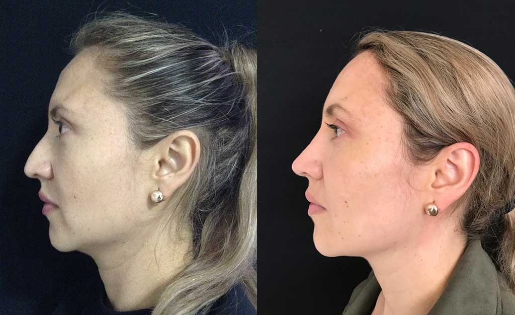 Disminución de dorso cartilaginoso + colocación de Spreader Graft + aumento de punta nasal + osteotomías resultado a los 9 meses y 10 días de cirugía.