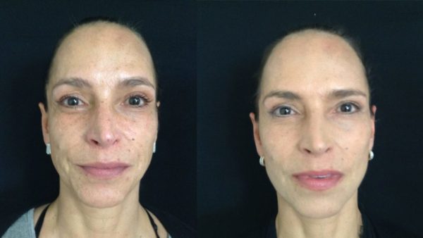 Rejuvenecimiento facial completo Resultado a los 4 meses de cirugía.