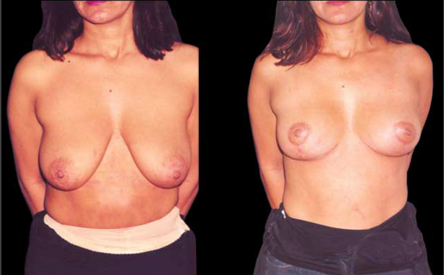 Mamopexia - Levantamiento de senos