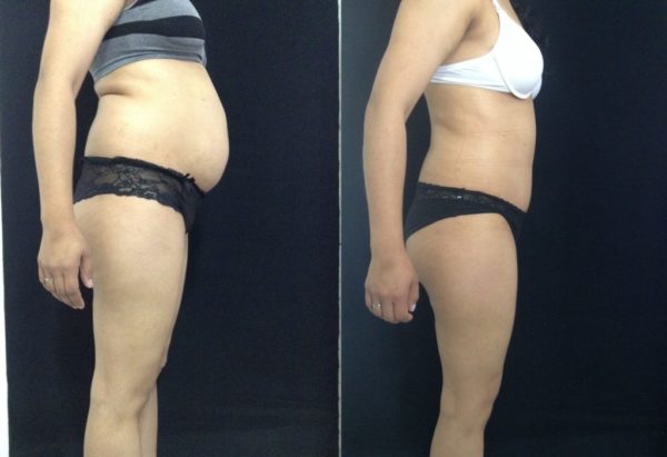 Abdominoplastia en Colombia