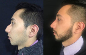 Rinoplastia para hombres - Cirugía de nariz hombres